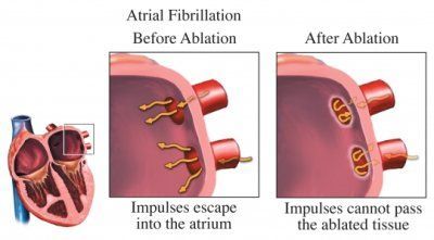 atrial fibrillation ablation